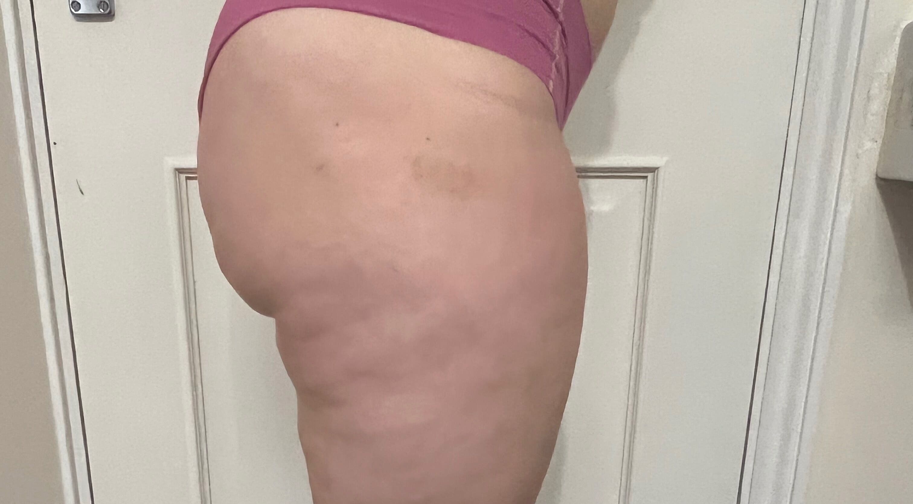 Close-up of a person's thigh at Diana Therapy, London, GB, showcasing skin texture care.