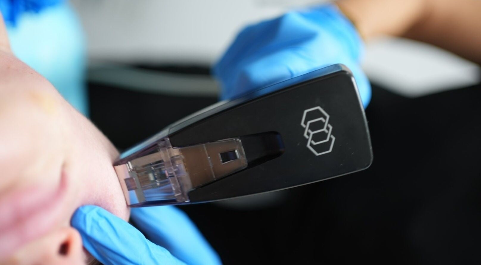 Close-up of SmoothSculpt treatment at Revival Med Spa Aesthetics, New York, New York, US.