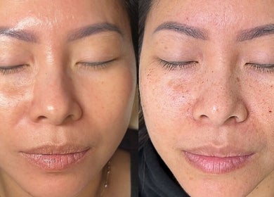 Before and after facial treatment at Skin Haus Aesthetics LLC, Miramar, Florida, US showing improved skin texture.