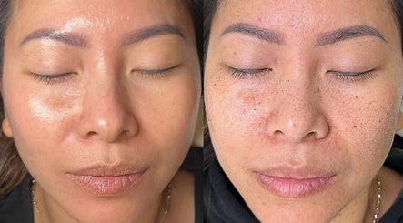 Before and after facial treatment at Skin Haus Aesthetics LLC, Miramar, Florida, US showing improved skin texture.
