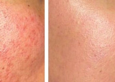 Before and after skin treatment at Skin Haus Aesthetics LLC, Miramar, Florida, US, showcasing improved texture.