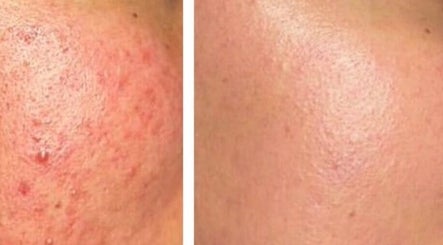 Before and after skin treatment at Skin Haus Aesthetics LLC, Miramar, Florida, US, showcasing improved texture.