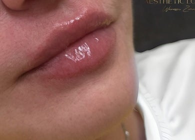 Close-up of glossy lips after treatment at WZAesthetics London, located in London, England, GB.