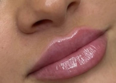 Close-up of glossy lips after treatment at WZAesthetics London in London, England, GB.