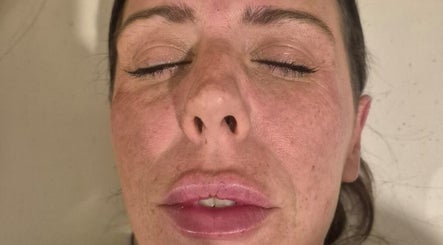 Close-up of a client's face post-treatment at Revive Aesthetics Herts, Watford, England, GB.