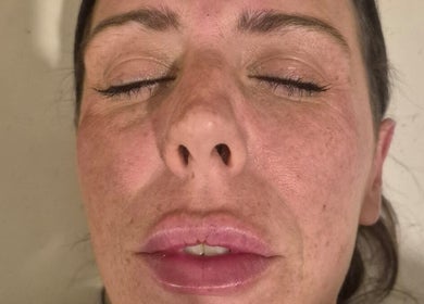 Relaxed face post-treatment at Revive Aesthetics Herts, Watford, England, GB, highlighting skin rejuvenation results.