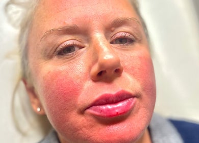 Close-up of facial rejuvenation treatment at Revive Aesthetics Herts in Watford, England, GB.