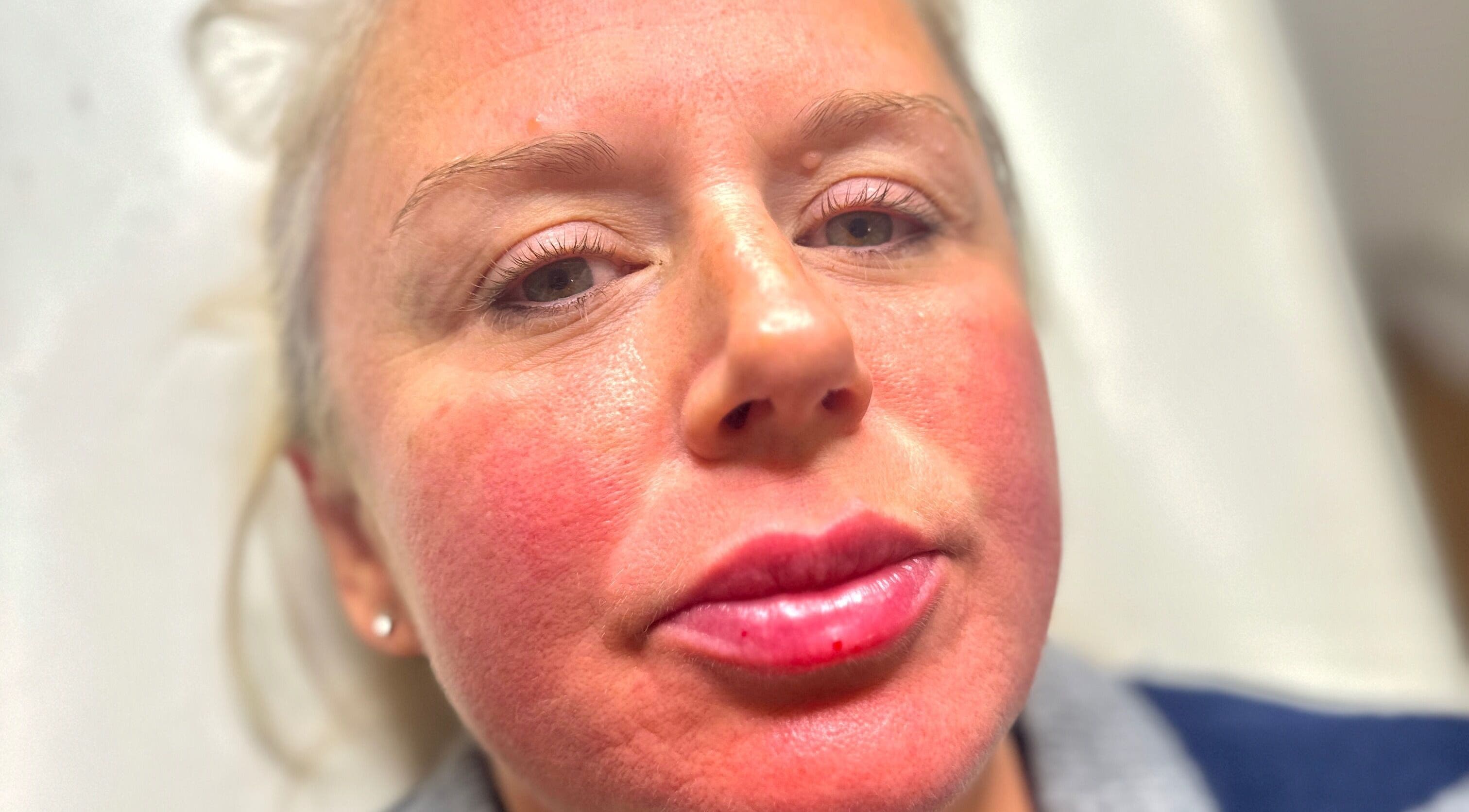 Close-up of post-treatment skin rejuvenation at Revive Aesthetics Herts, Watford, England, GB.