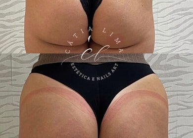 Body contouring results at Cátia Lima Beauty, Montijo, Setúbal, PT