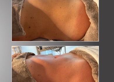 Body contouring results at Cátia Lima Beauty, Montijo, Setúbal, PT showcasing toned skin transformation.