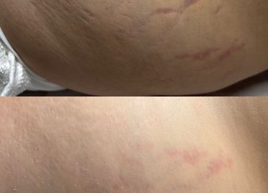 Before and after stretch mark treatment at Cátia Lima Beauty in Montijo, Setúbal, PT.