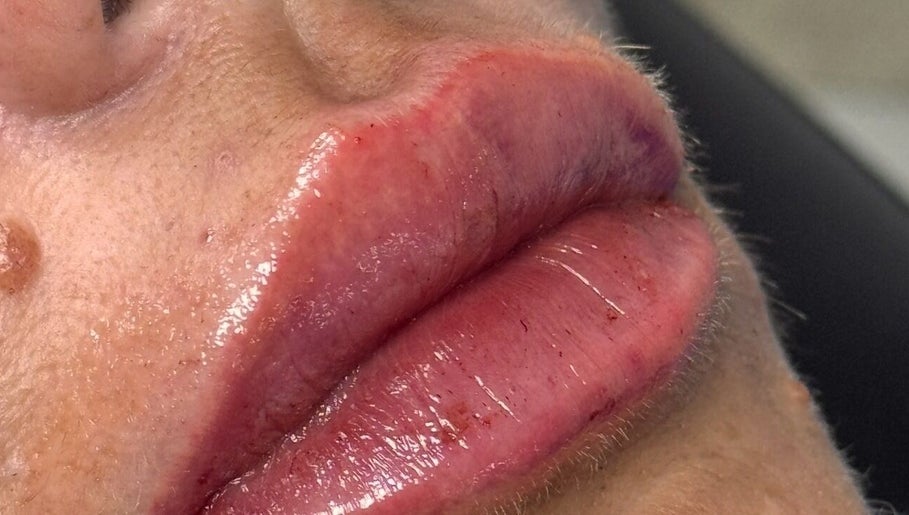 Lip enhancement result at Khloe Sculpt Aesthetics in Caterham, England, GB. Smooth, plump appearance.