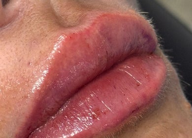 Lip enhancement result at Khloe Sculpt Aesthetics in Caterham, England, GB. Smooth, plump appearance.