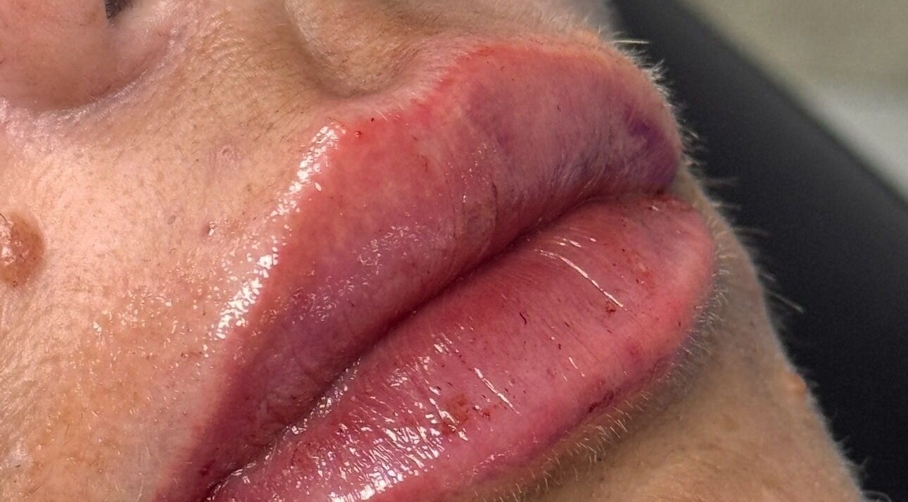 Lip enhancement treatment at Khloe Sculpt Aesthetics in Caterham, England, GB.