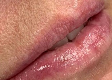 Close-up of glossy lips at Hydro Clinic, Liverpool, England, GB, showcasing lip enhancement results.