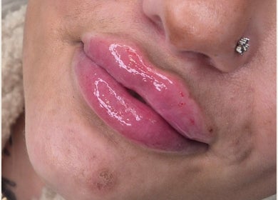 Close-up of glossy, enhanced lips at Ipswich beauty venue, Ipswich, England, GB.