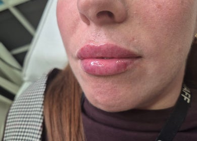 Glossy, enhanced lips at beauty venue Ipswich, England, GB.