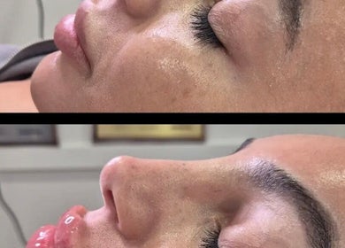 Before and after facial treatment at Ipswich beauty venue, Ipswich, England, GB.