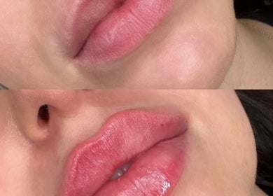 Lip enhancement before and after at Ipswich, England, GB, showcasing improved volume and shape.