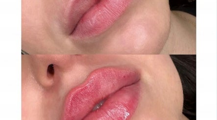 Lip enhancement before and after at Ipswich, England, GB, showcasing improved volume and shape.