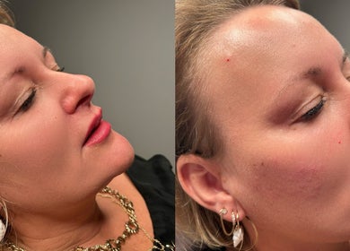Client skincare results at Beauty Station, Brighton And Hove, England, GB. Smooth, radiant complexion.