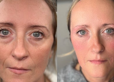 Before and after facial treatment at Beauty Station in Brighton And Hove, England, GB, showing noticeable skin improvement.