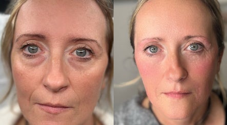 Before and after facial treatment at Beauty Station in Brighton And Hove, England, GB, showing noticeable skin improvement.
