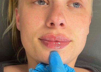 Close-up of lip enhancement at Flawless Moments, North Shields, England, GB.
