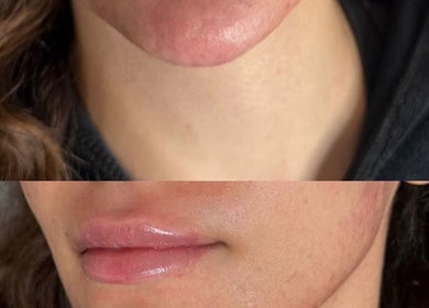 Close-up of lip treatment results at Blacks clinic, Watford, England, GB, showcasing improved smoothness.