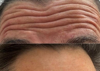Forehead before and after treatment at Blacks clinic, Watford, England, GB showing reduced wrinkles.