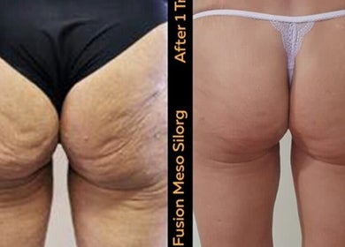 Before and after body contouring at The SLiM Solution, Jeffreys Bay, Eastern Cape, ZA.