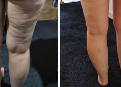 Leg transformation before and after at The SLiM Solution, Jeffreys Bay, Eastern Cape, ZA showcasing smooth skin.