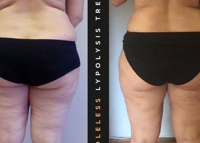 Before and after weight loss treatment at The SLiM Solution, Jeffreys Bay, Eastern Cape, ZA.