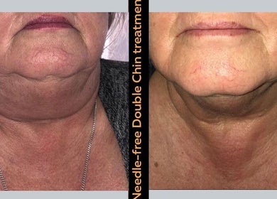Before and after needle-free chin treatment at The SLiM Solution, Jeffreys Bay, Eastern Cape, ZA.