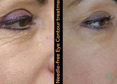 Before and after needle-free eye contour at The SLiM Solution, Jeffreys Bay, Eastern Cape, ZA.