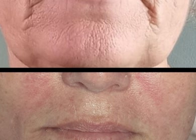 Before and after skin treatment at The SLiM Solution, Jeffreys Bay, Eastern Cape, ZA showing improved complexion.