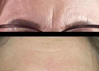 Before and after forehead treatment at The SLiM Solution, Jeffreys Bay, Eastern Cape, ZA.