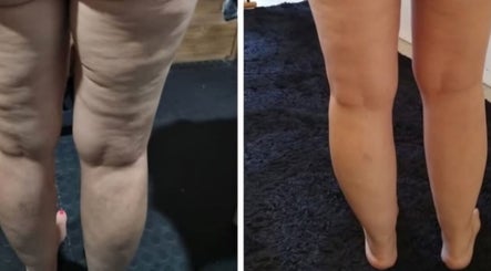 Before and after leg transformation at The SLiM Solution in Jeffreys Bay, Eastern Cape, ZA.