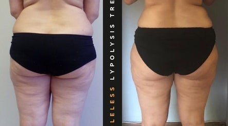 Before and after body contouring at The SLiM Solution, Jeffreys Bay, Eastern Cape, ZA. Visible results of lypolysis.