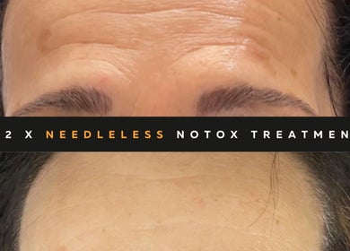 Before and after needleless forehead treatment at The SLiM Solution, Jeffreys Bay, Eastern Cape, ZA.