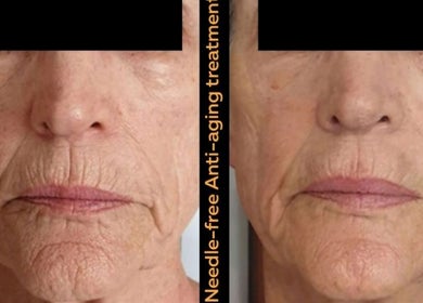 The SLiM Solution in Jeffreys Bay, Eastern Cape, ZA offers visible anti-aging results with needle-free treatments.