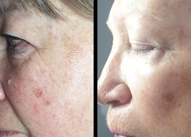 Before and after skin treatment at The SLiM Solution, Jeffreys Bay, Eastern Cape, ZA. Visible skin improvements.