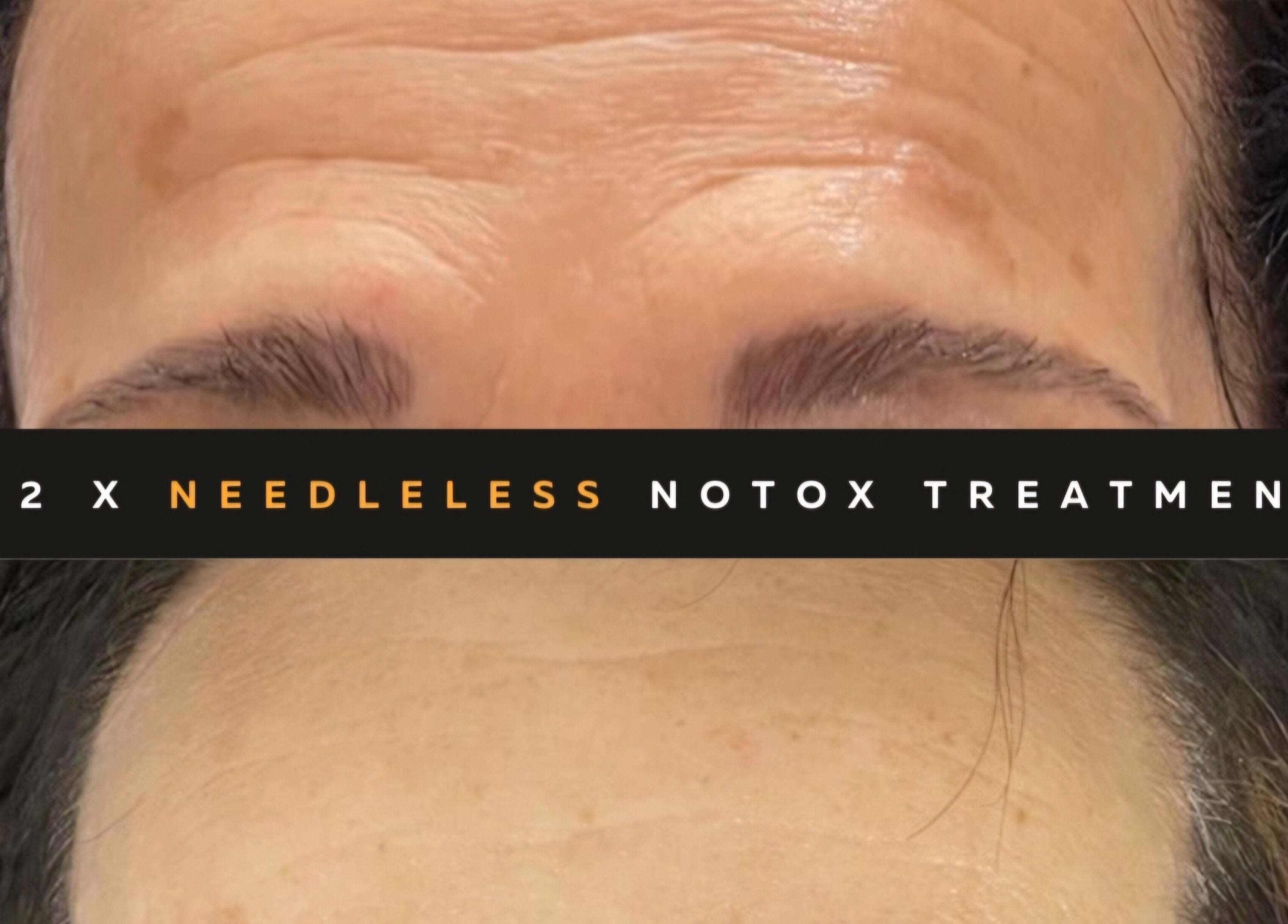 Before and after of needleless treatment at The SLiM Solution, Jeffreys Bay, Eastern Cape, ZA.