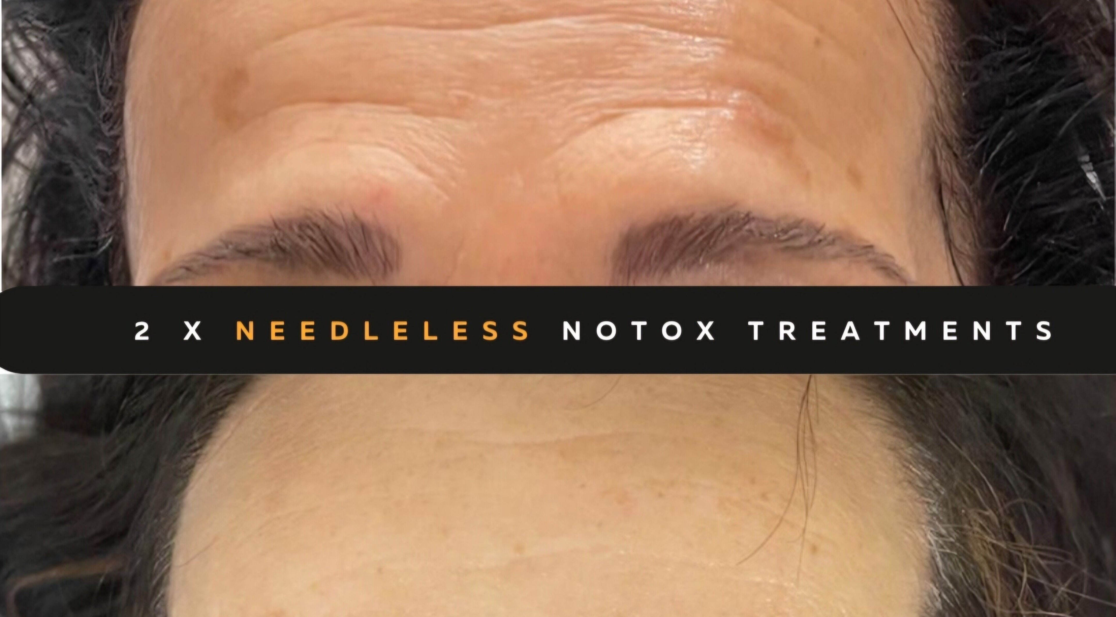 Before and after of needleless treatment at The SLiM Solution, Jeffreys Bay, Eastern Cape, ZA.