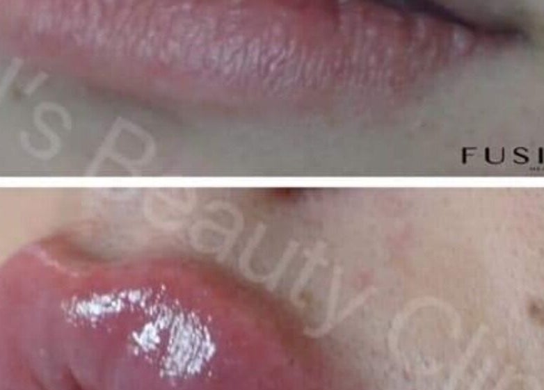 Before and after lip enhancement at The SLiM Solution, Jeffreys Bay, Eastern Cape, ZA, showcasing smooth, glossy results.