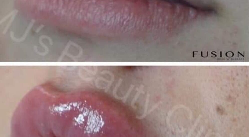 Before and after lip enhancement at The SLiM Solution, Jeffreys Bay, Eastern Cape, ZA, showcasing smooth, glossy results.