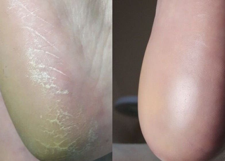Before and after heel treatment at AFA Studio Nails & Beauty, Dublin, County Dublin, IE.