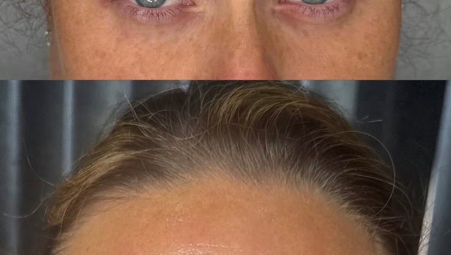 Before and after skin treatment at Bareface Skin Clinic, Liverpool, England, GB highlighting facial rejuvenation.