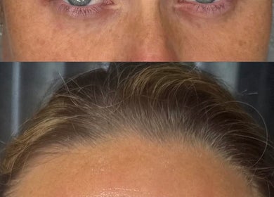 Before and after skin treatment at Bareface Skin Clinic, Liverpool, England, GB highlighting facial rejuvenation.