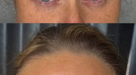 Before and after skin treatment at Bareface Skin Clinic, Liverpool, England, GB highlighting facial rejuvenation.